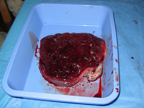placenta